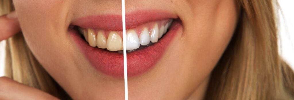 A quoi sert le vernis fluoré en soins dentaires ?